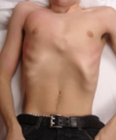 Postural example of a Right Brachial Chain (R BC) pattern showing asymmetrical rib cage position with right rib flare and altered upper trunk orientation, commonly addressed in PRI-based physical therapy.