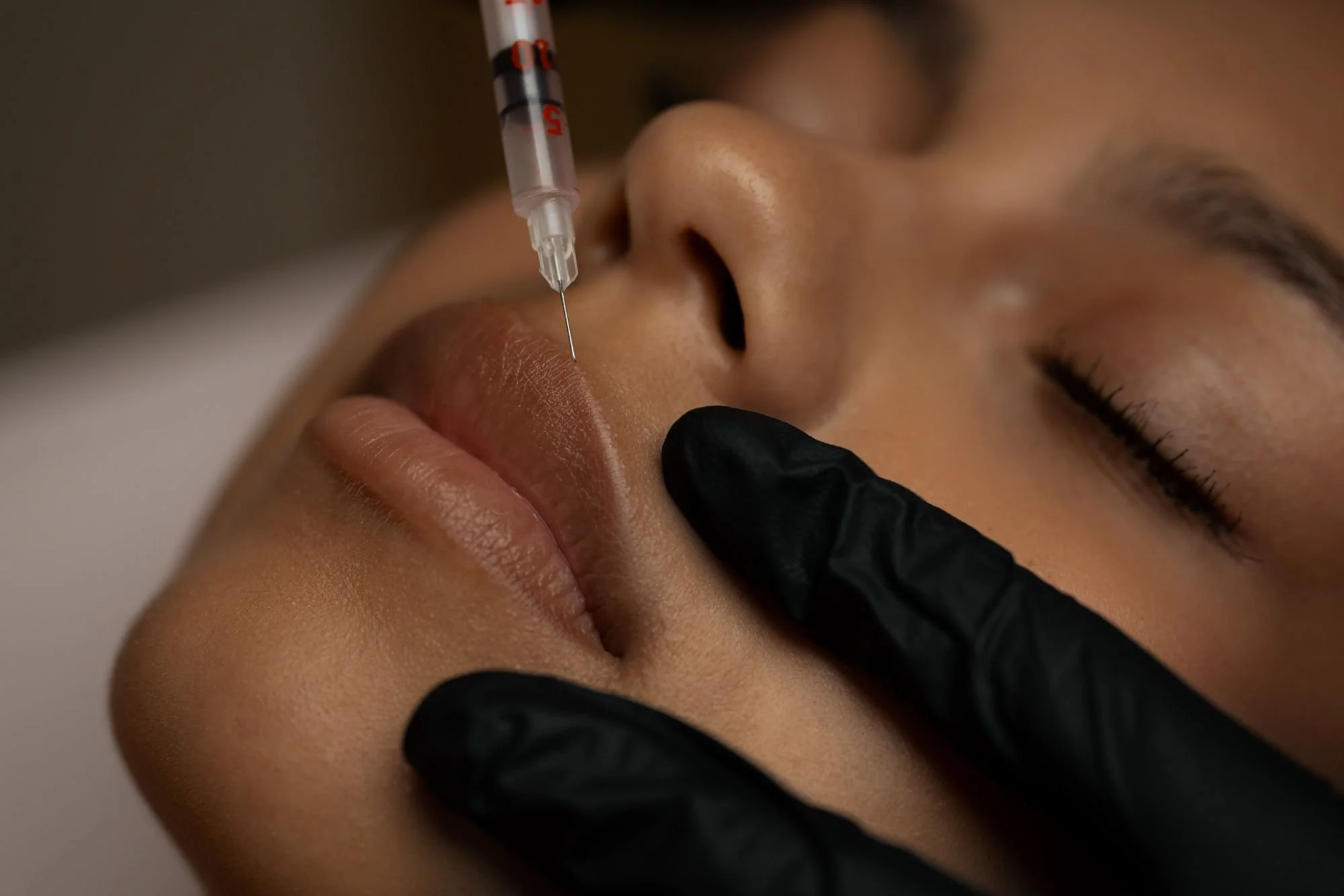 Close up of a dermal filler being injected into a woman's upper lip.