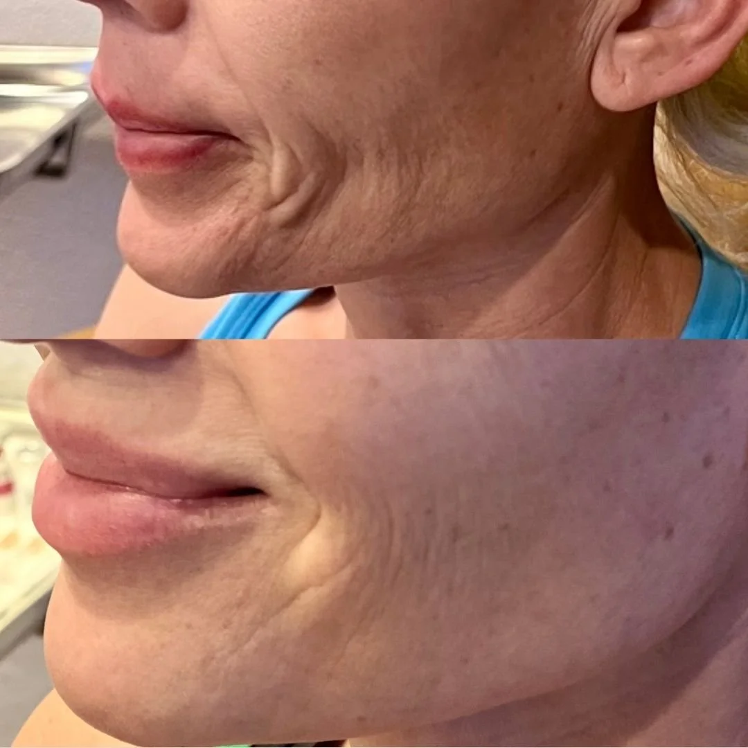 Before and after comparison of a woman's face, highlighting improvements in skin texture and reduction of wrinkles on the cheek and jawline.