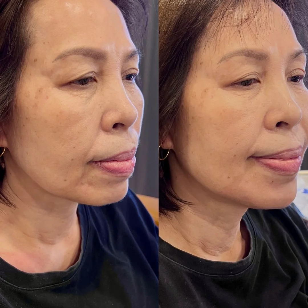 Side-by-side comparison of a woman's face, showing visible skin improvement and reduced age spots on the right after skincare treatment.