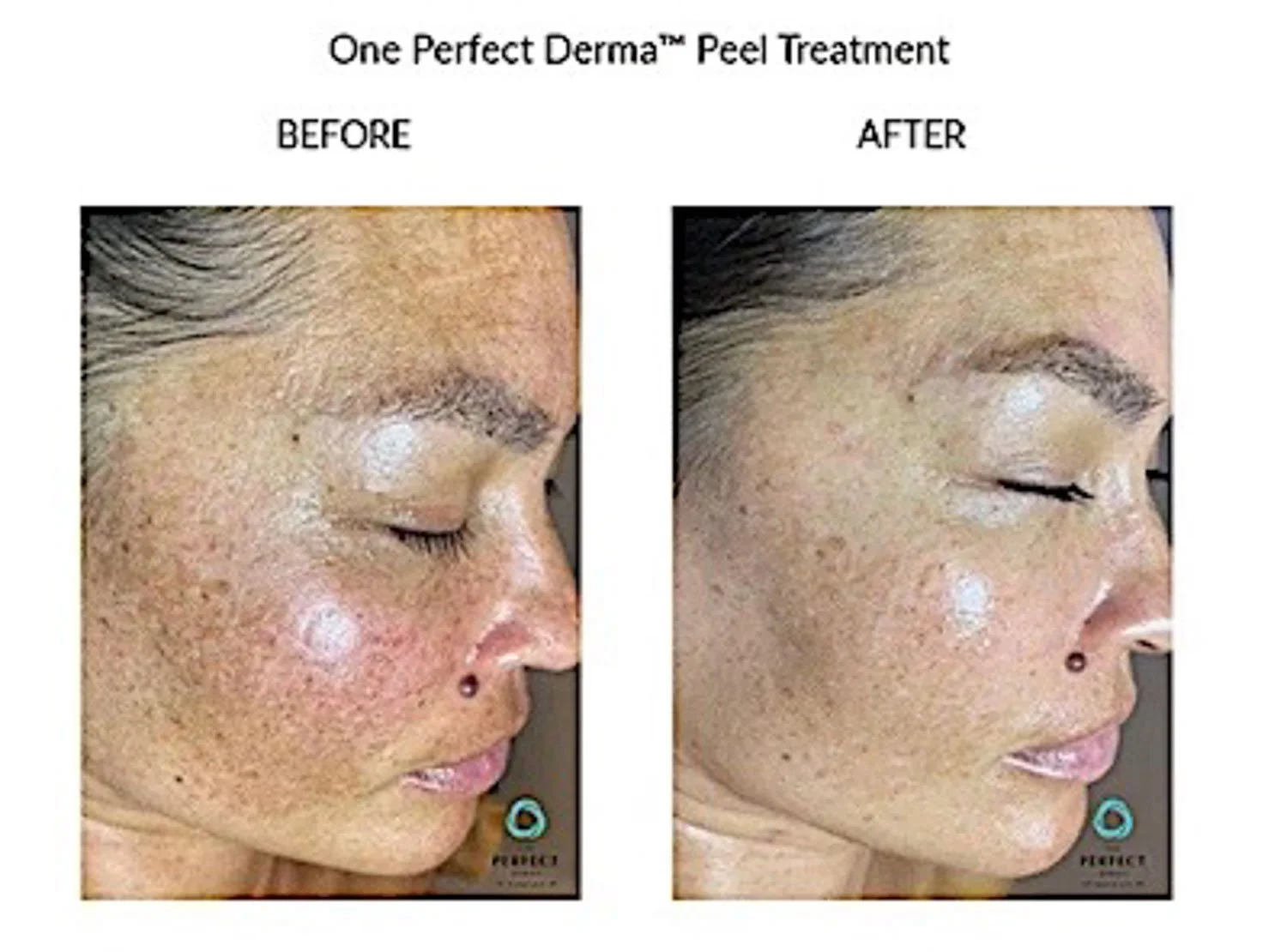 Side-by-side comparison of a woman's face before and after using One Perfect Derma Peel Treatment, showing clearer skin post-treatment.