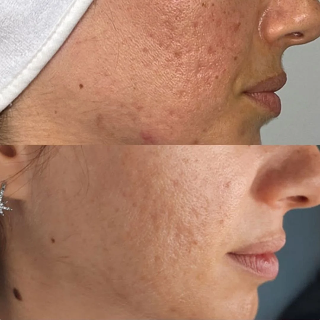 Before and after images of a woman's face showing skin improvement, with the top image depicting skin with hyperpigmentation and blemishes, and the bottom image showing clearer, smoother skin.