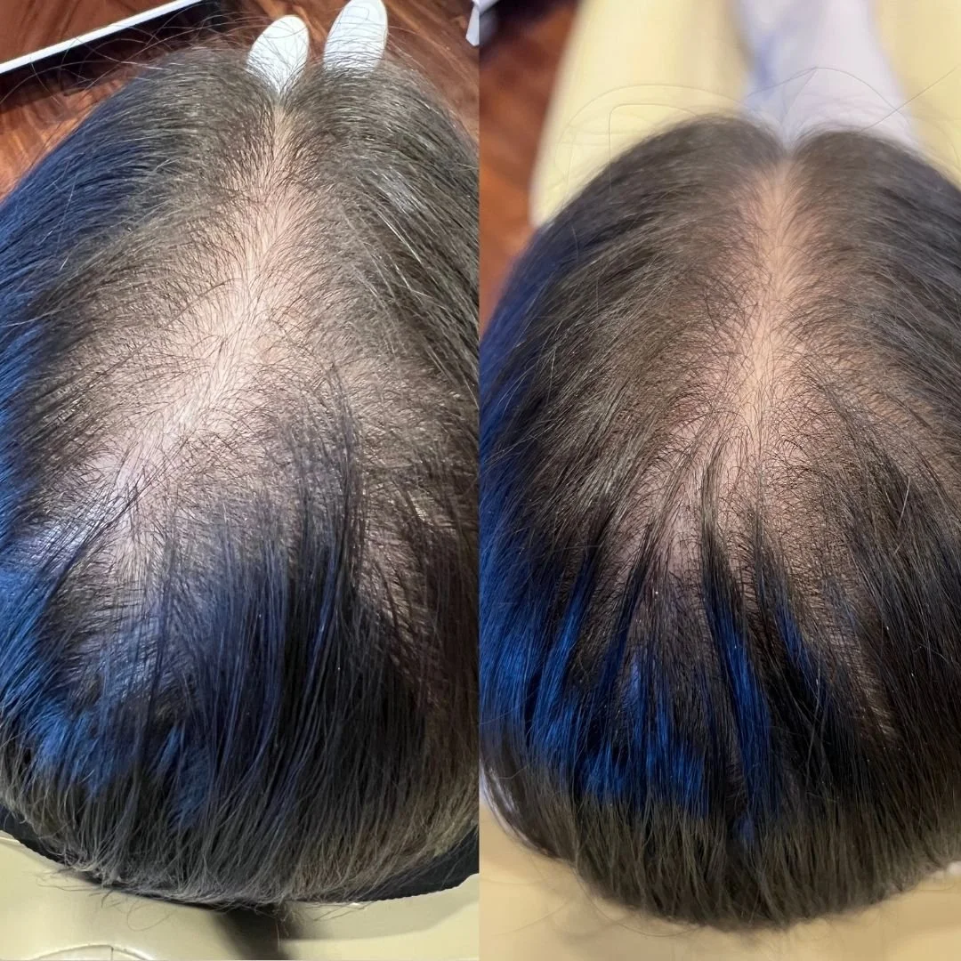 Comparison of a person's scalp before and after hair treatment, showing increased hair density and reduced scalp visibility.