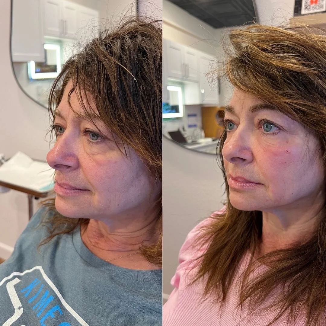 Side-by-side comparison of a woman before and after a cosmetic procedure, showcasing improvements in skin appearance and overall face contour.