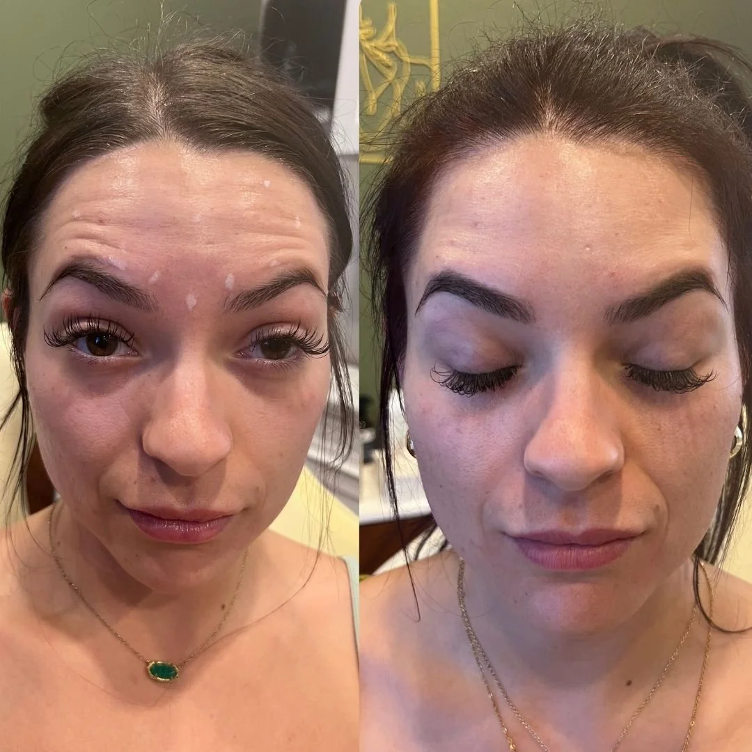 Side-by-side comparison of a woman before and after a skincare or cosmetic procedure, with the left showing her with makeup, acne scars, and blemishes, and the right showing clearer, smoother skin with her eyes closed.