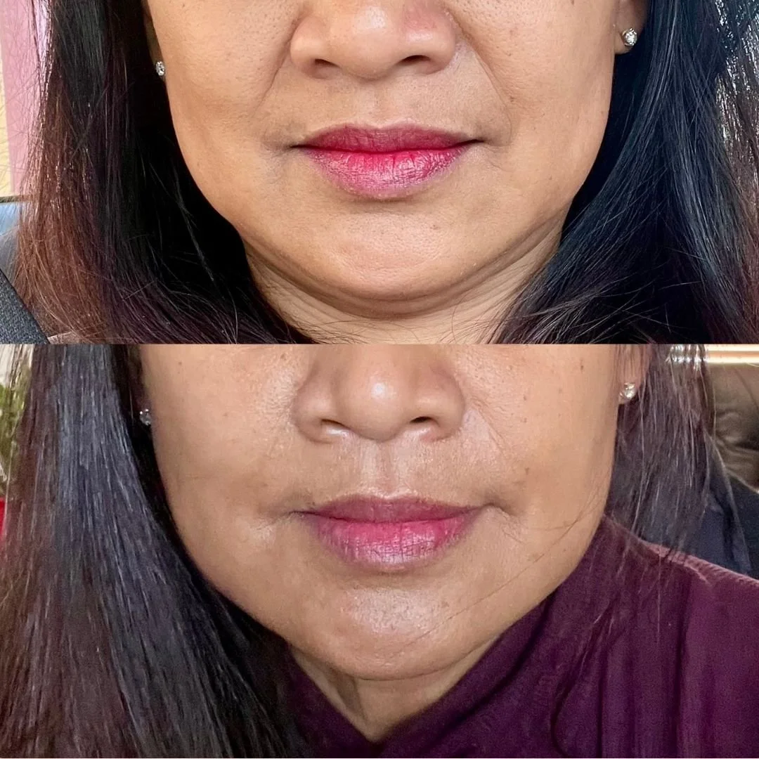 Close-up of a woman's lips, showing a before and after comparison of a cosmetic procedure, with dark hair and pearl earrings.