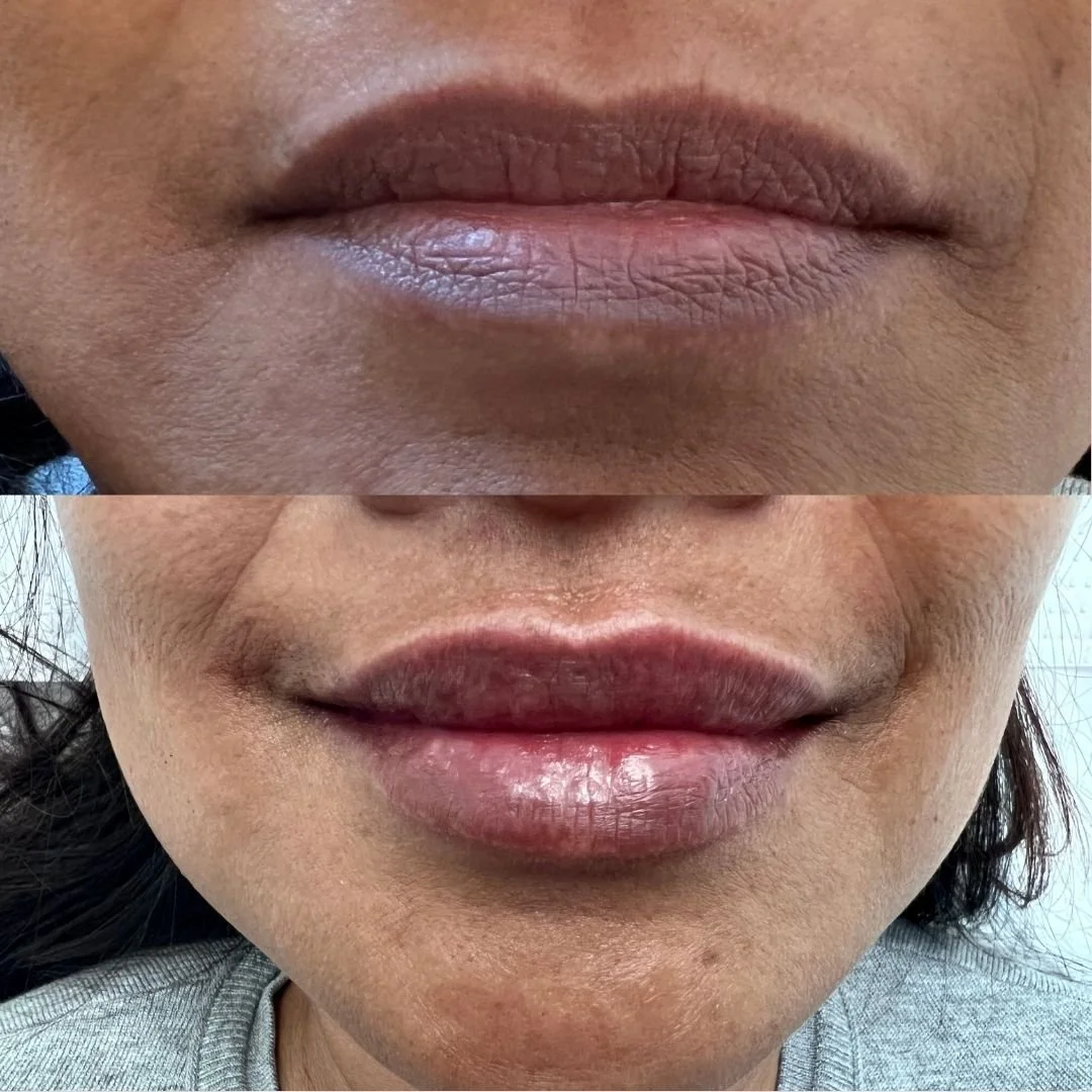 Close-up of a person's lips, showing before and after lip appearance, with smoother and more defined lips in the after image.