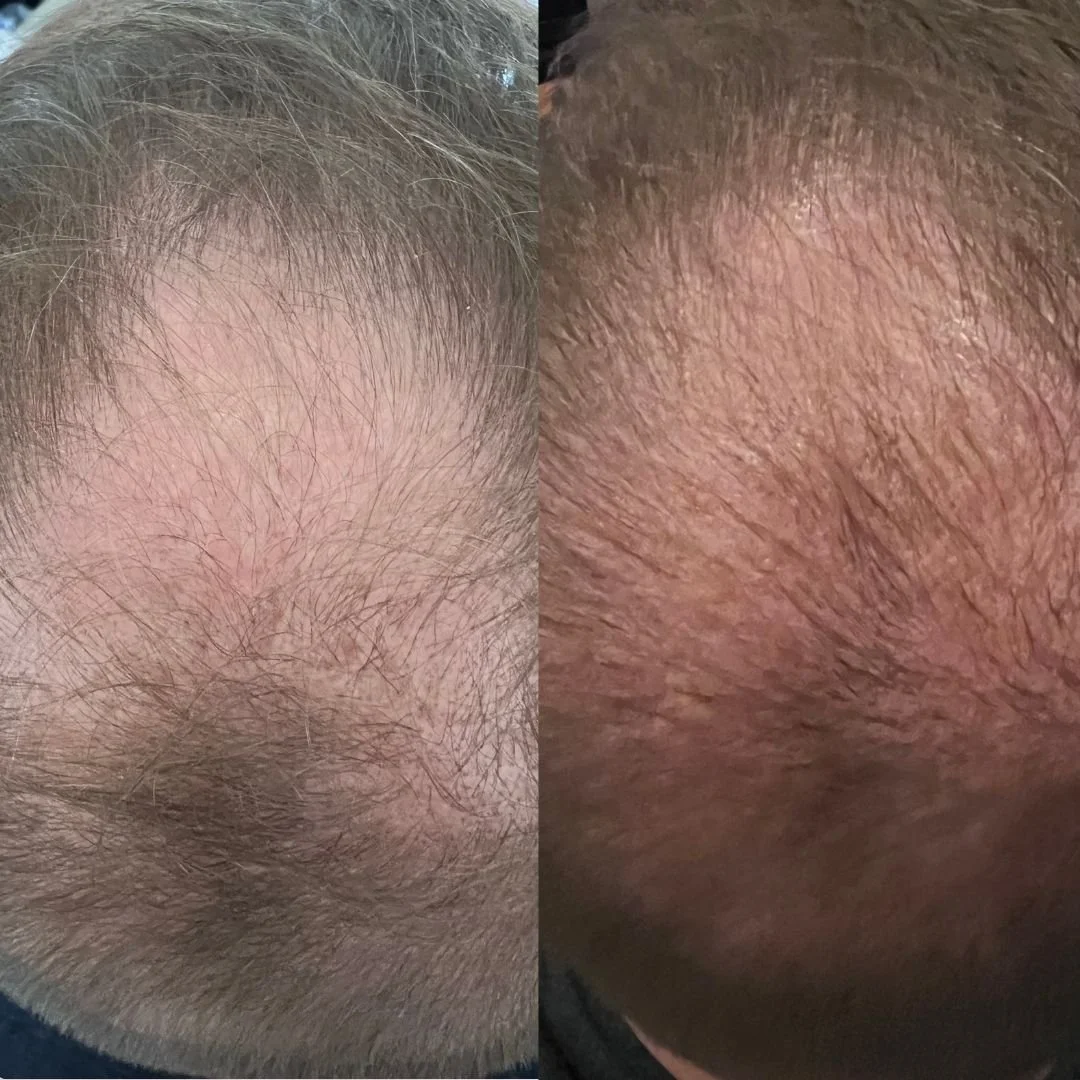 Comparison of a balding scalp with thinning hair on the left and a bald, shiny scalp on the right.