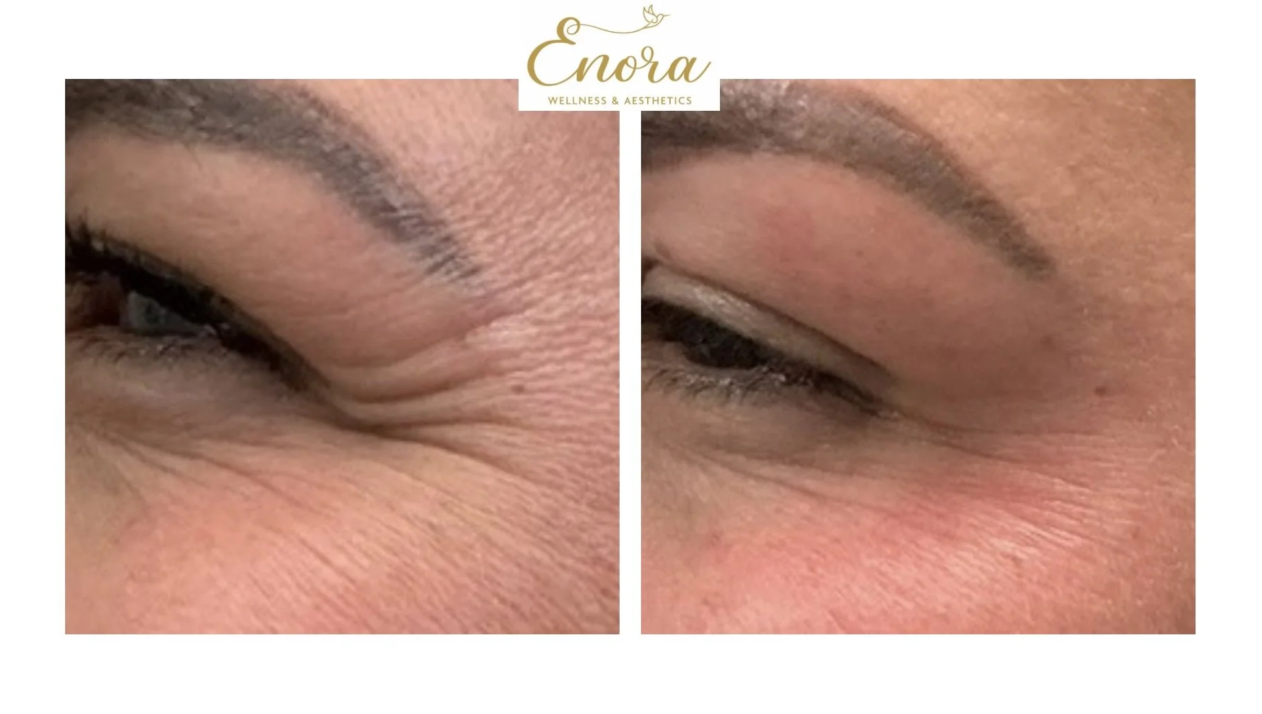 Close-up of a person's eye area showing before and after skin treatment, with improved skin texture and reduced wrinkles.