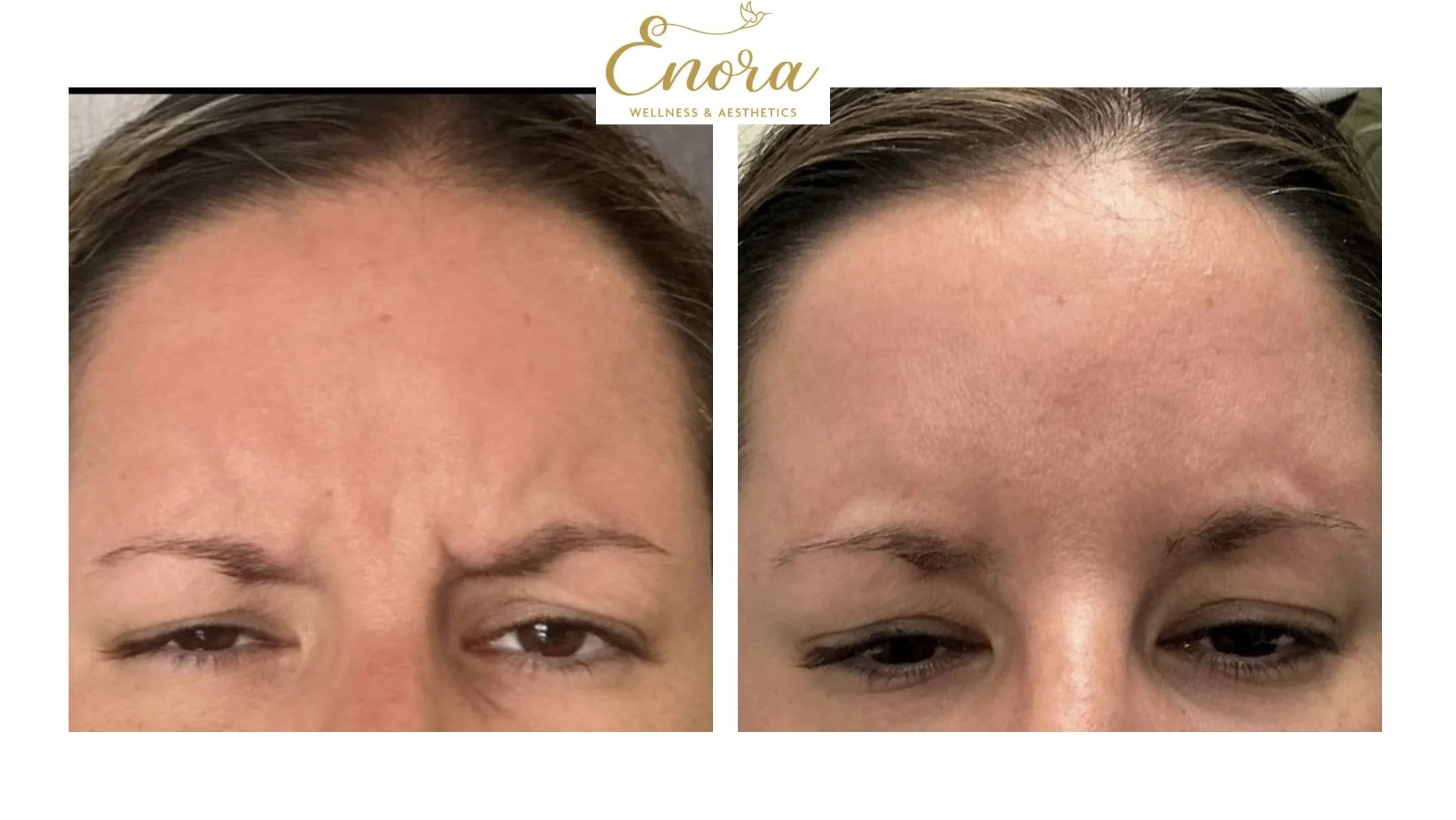 Close up image of a woman's face focused on the area in between her eye brows that shows before and after results from treating 11 lines with tox.