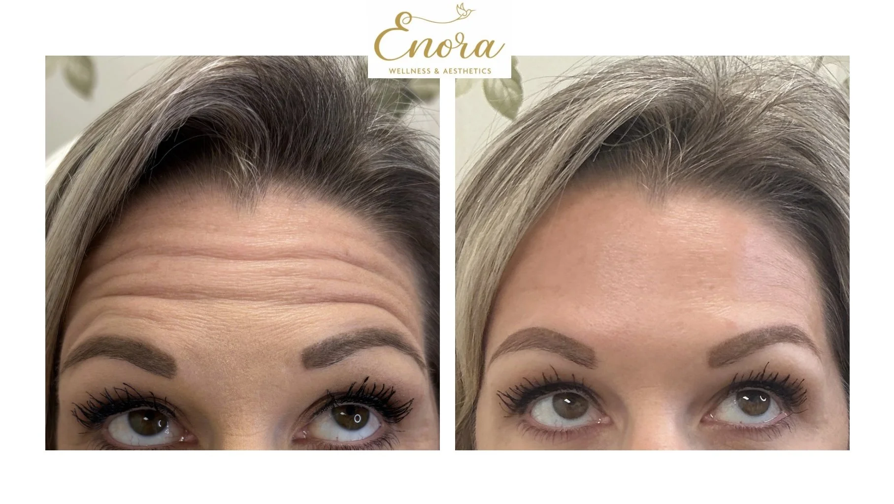 Close-up of a person's forehead area showing before and after skin treatment, with improved skin texture and reduced wrinkles.