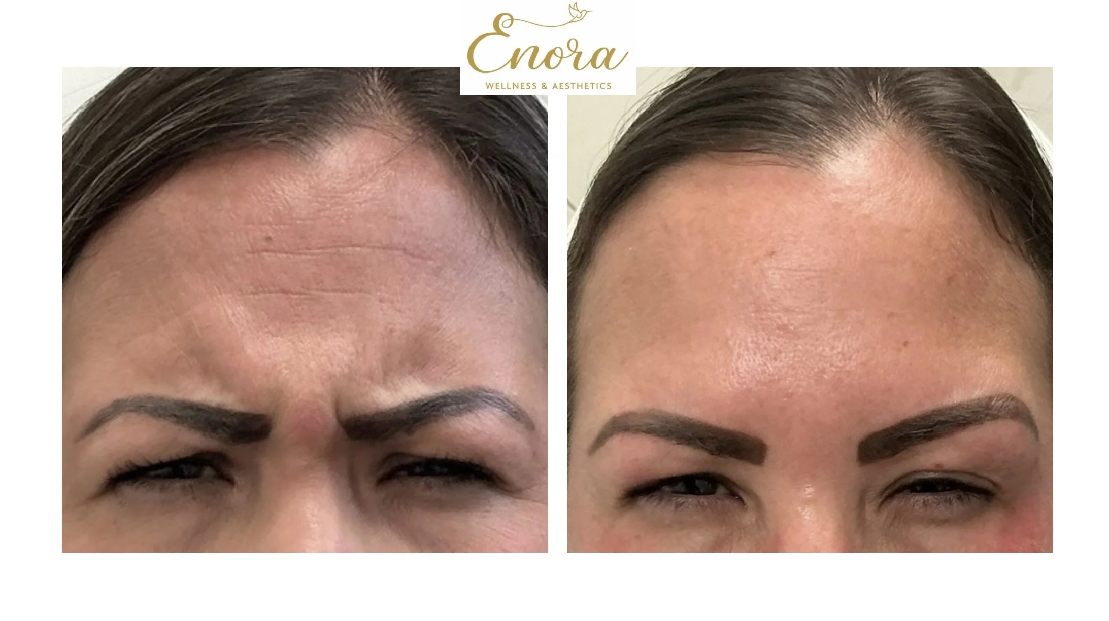 Close up of a female client that shows before and after results from a Tox treatment to improve frown lines