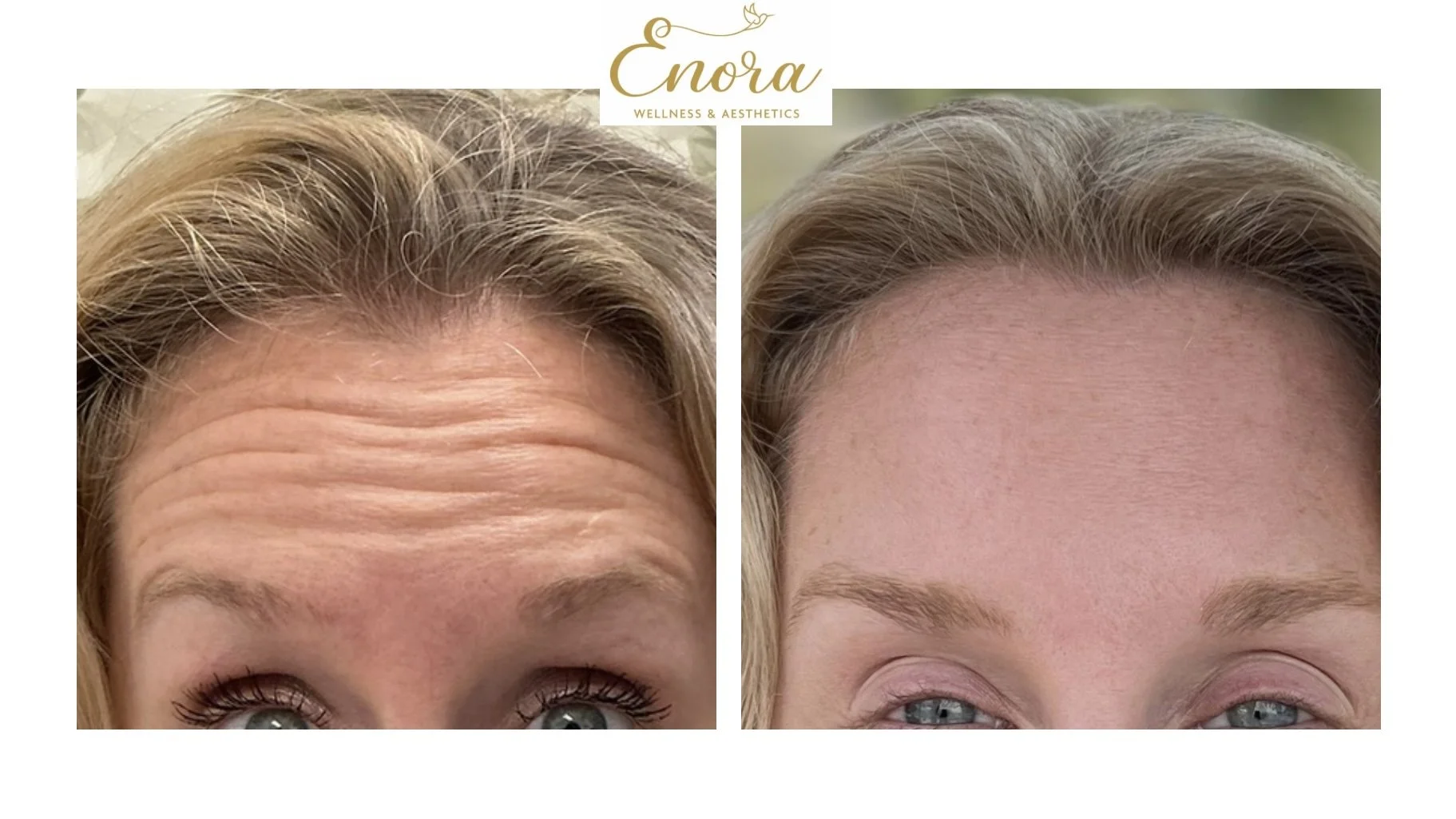 Side-by-side close-up images of a person's forehead, showing before and after results from tox services with the text over top of the image that says 'Enora Wellness & Aesthetics'.