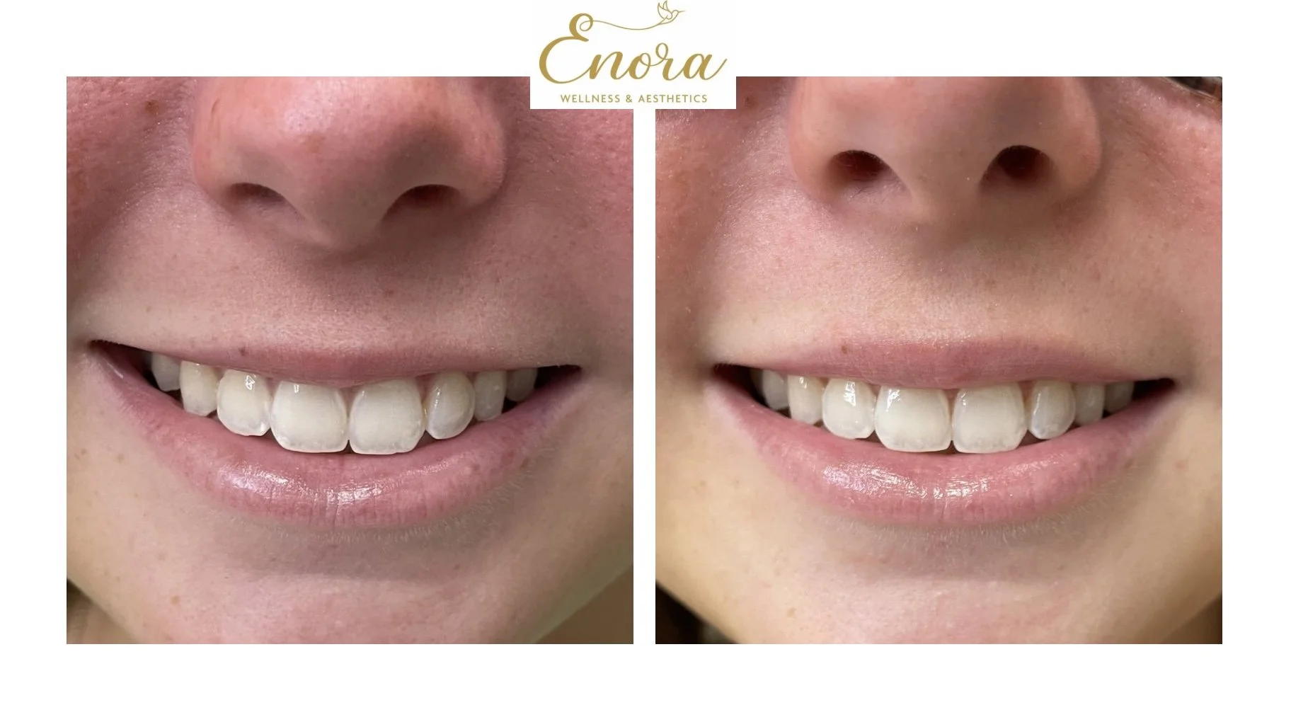 Side-by-side comparison of a lip flip client at Enora