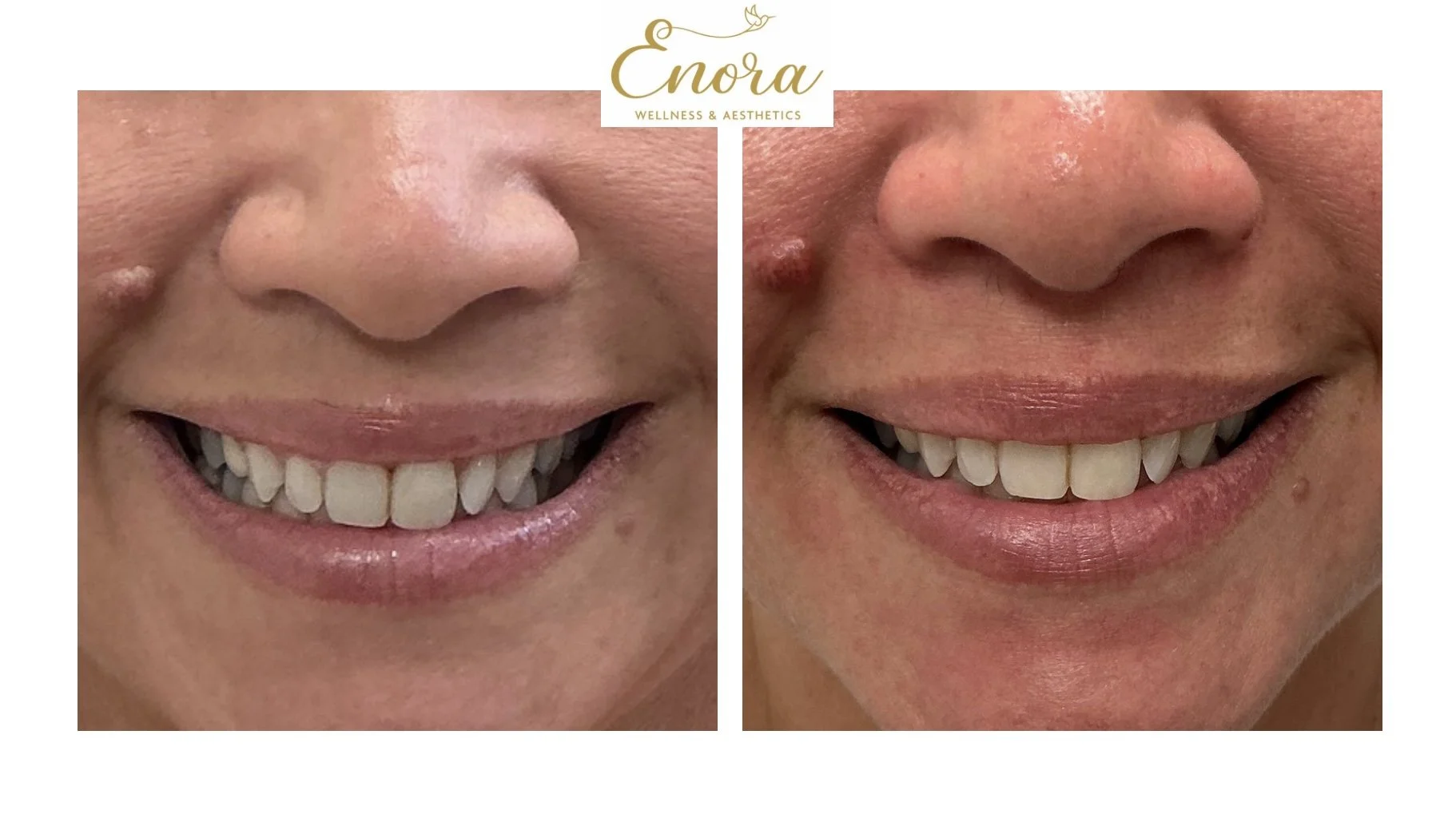 Side-by-side close-up images of a person's lips, showing before and after results from a lip flip services with the text over top of the image that says 'Enora Wellness & Aesthetics'.