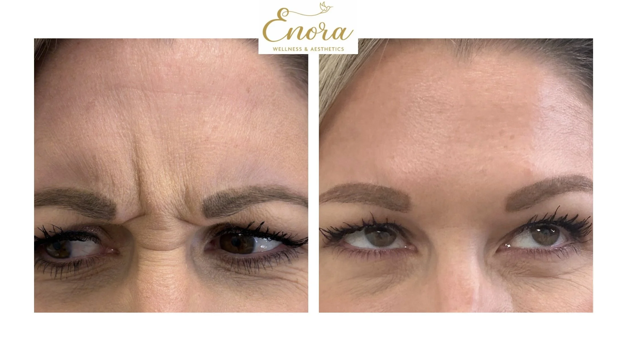 Before and after results of a female client that had her 11 lines treated