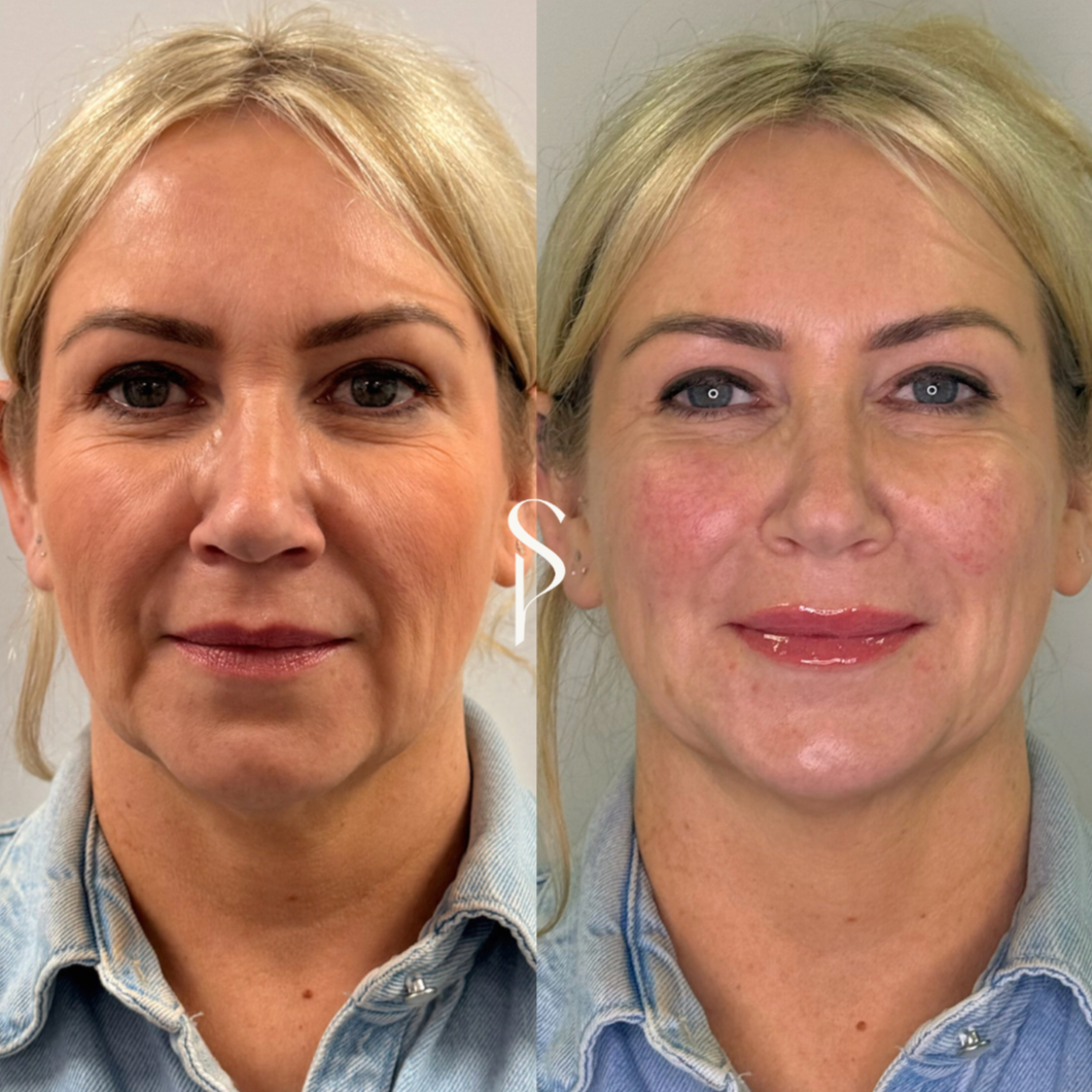 Side-by-side comparison of a woman's face before and after skincare or cosmetic treatment, showing improved skin texture and appearance, with the woman smiling in the after photo.