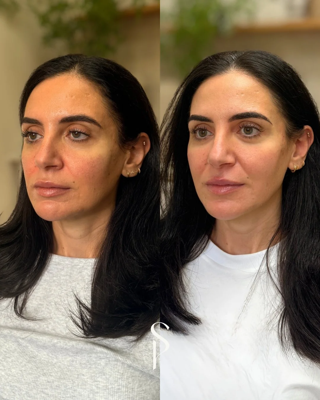 Honeys! Our goal is never to make you look like someone else, it&rsquo;s to look refreshed, balanced and quietly confident.⁠
⁠
This beautiful result was achieved through a combination of:⁠
💉 Cheek + Chin + Jawline contouring for structure⁠
💫 Sculpt