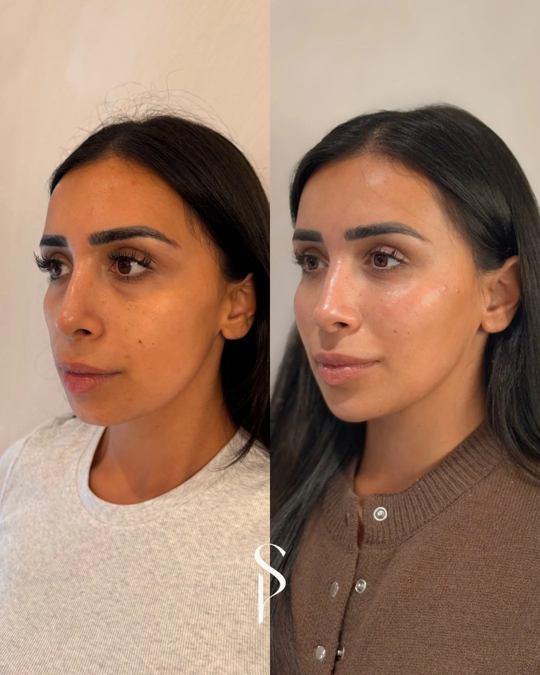 The goal isn&rsquo;t to add more, it&rsquo;s to create balance. ✨⁠
⁠
This beautiful result was achieved with just 2ml of dermal filler - strategically placed to restore structure, definition, and natural lift.⁠
⁠
Every face tells its own story.⁠
That