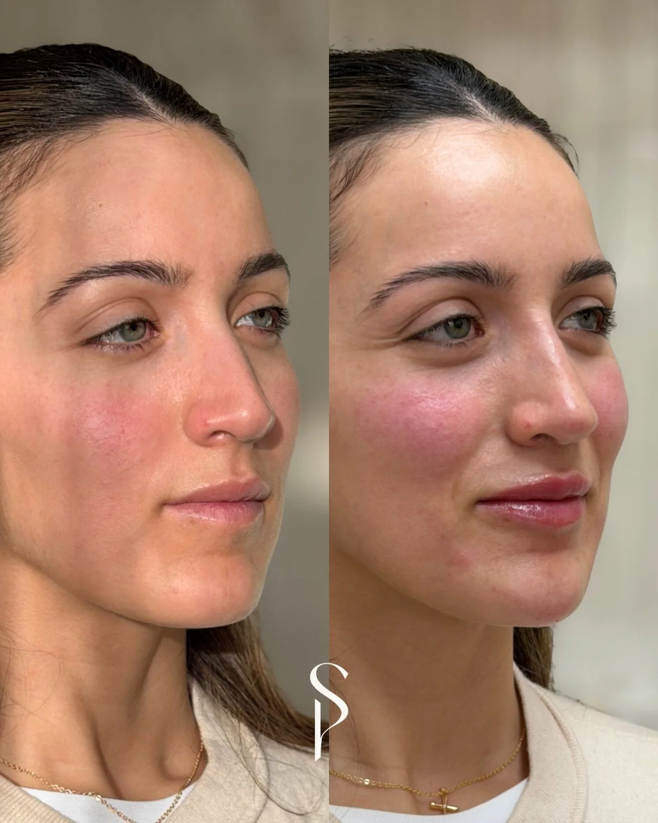 Facial harmonisation isn&rsquo;t about changing your face - it&rsquo;s about bringing balance back to it ✨⁠
⁠
Every face tells a story, and my job is to listen.⁠
Subtle structure, softened transitions, restored support&hellip; the kind of results whe
