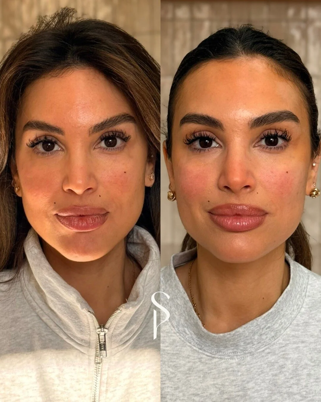 A small tweakment at the right time makes all the difference.
After years of saying 'not yet', we placed a small amount of filler to restore structural support through the cheeks and rebalance the face.

The goal was never to change Melly&rsquo;s fea
