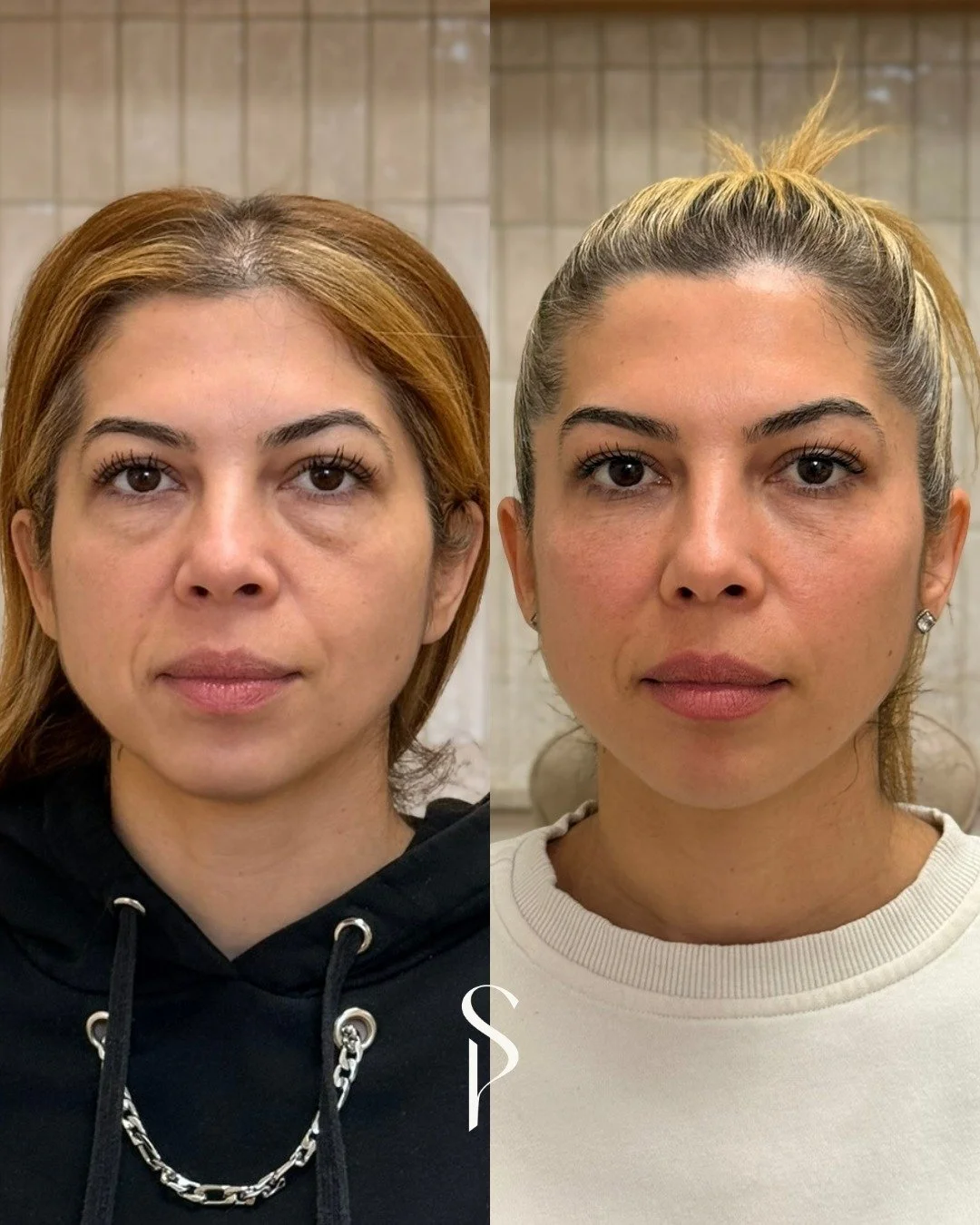 Most people think filler is about adding volume.

But when it&rsquo;s done properly, it&rsquo;s about taking away that tired look you can&rsquo;t quite put your finger on.

Nicoleta didn&rsquo;t want to look different. She just wanted her face to fee