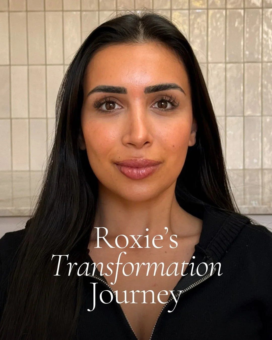 From July 2025 to now, this is what a considered, long-term approach to aesthetics truly looks like.

Roxie initially came to us wanting to refresh her lips ahead of her wedding, but a full assessment revealed that the concern wasn&rsquo;t a lack of 