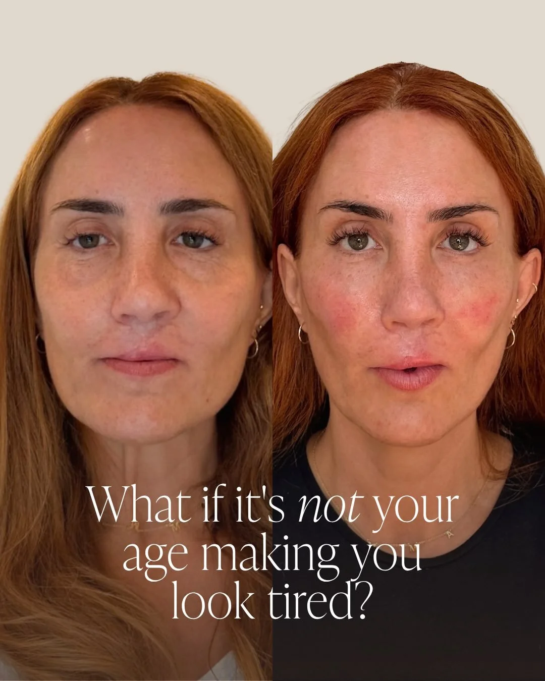 Looking tired doesn&rsquo;t always mean you need more volume.

Sometimes the best thing we can do is pause, reassess and treat what the face actually needs. 

The goal? Not to make her look different. Just rested, balanced and still completely hersel
