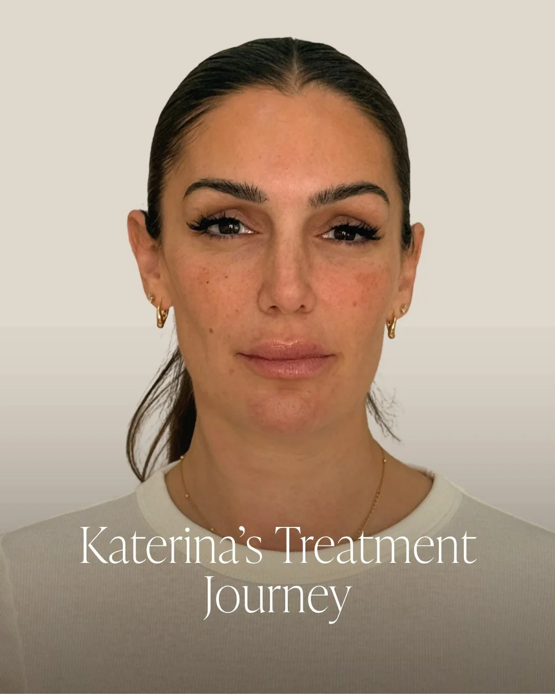 Sometimes you don&rsquo;t need more treatment. You need someone to work out what comes first.

For Katerina, that meant looking at her face as a whole and building the plan step by step, from movement and under-eye quality to resetting her lips befor
