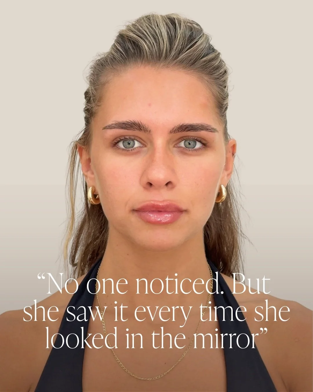 Sometimes, the smallest changes make the biggest difference.

For Lucia, it was all about creating more balance while keeping her lips naturally hers 💗

Book your consultation through the link in our bio.