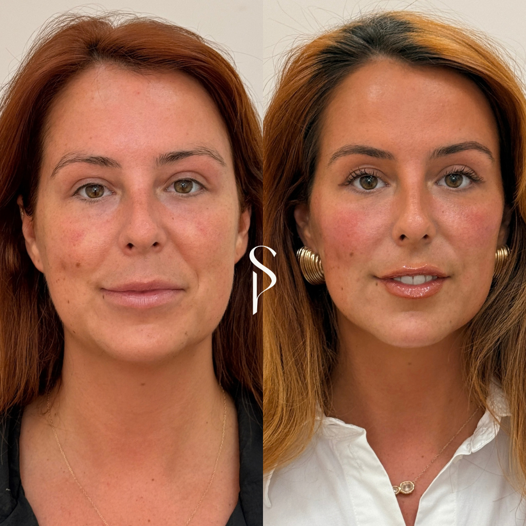 Side-by-side comparison of a woman's face before and after skincare or cosmetic treatment, showing improved skin texture and appearance, with the woman smiling in the after photo.