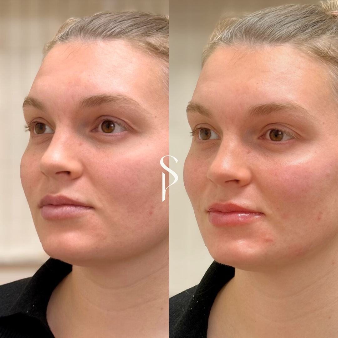 Side-by-side comparison of a woman before and after a skincare or cosmetic treatment, showing improved skin tone and texture.