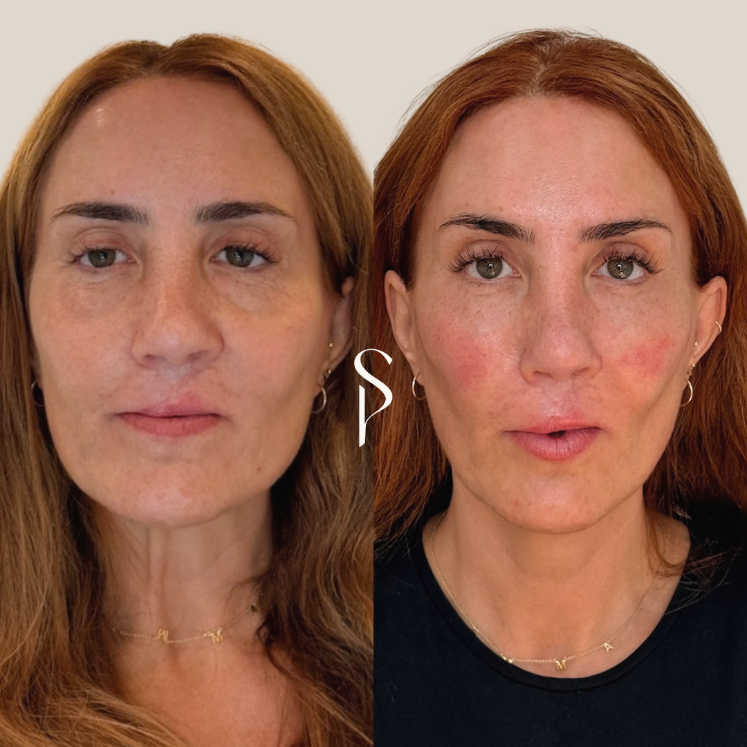 Side-by-side comparison of a woman before and after a skincare or cosmetic treatment, showing improved skin tone and texture.