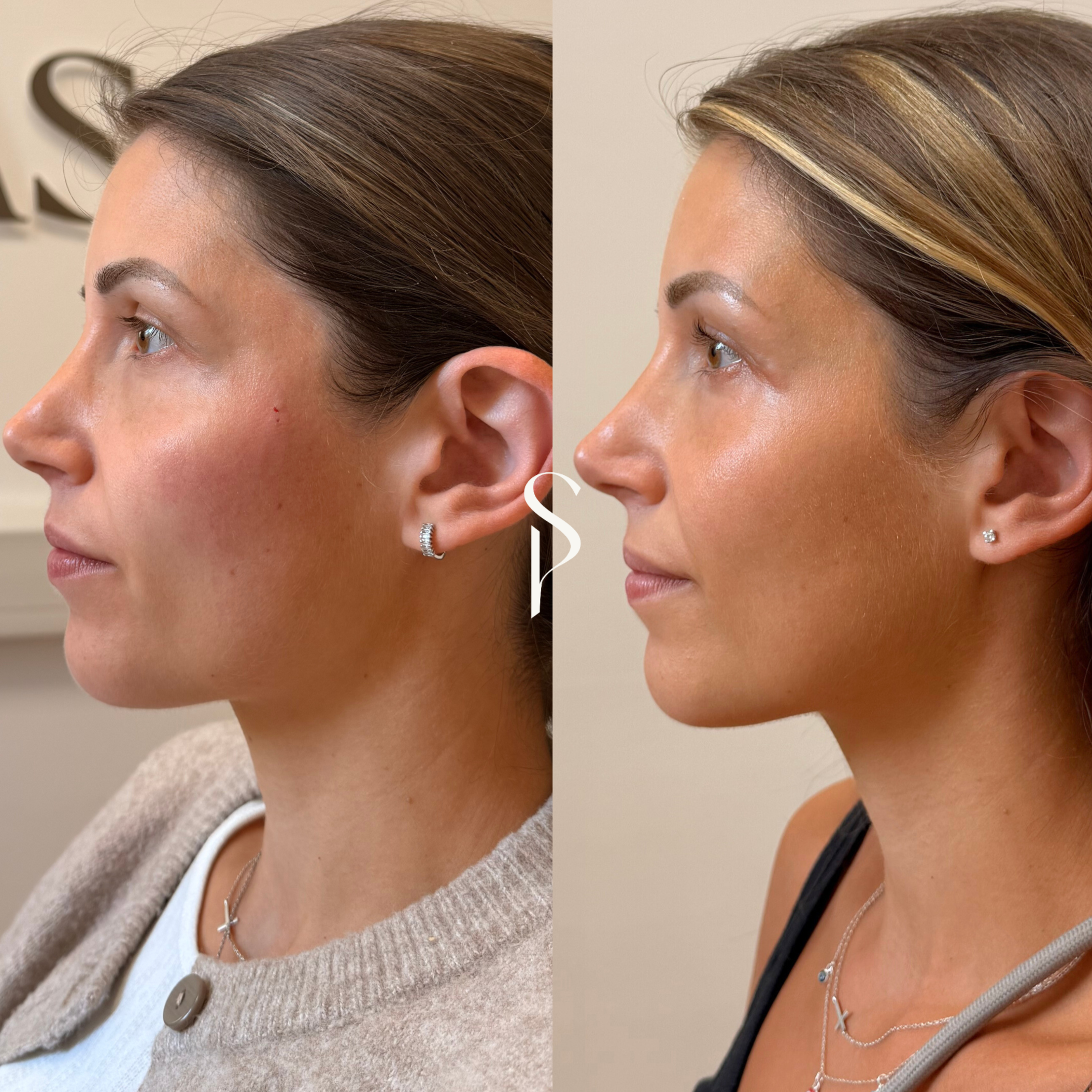 Side-by-side comparison of a woman before and after a skincare or cosmetic treatment, showing improved skin tone and texture.