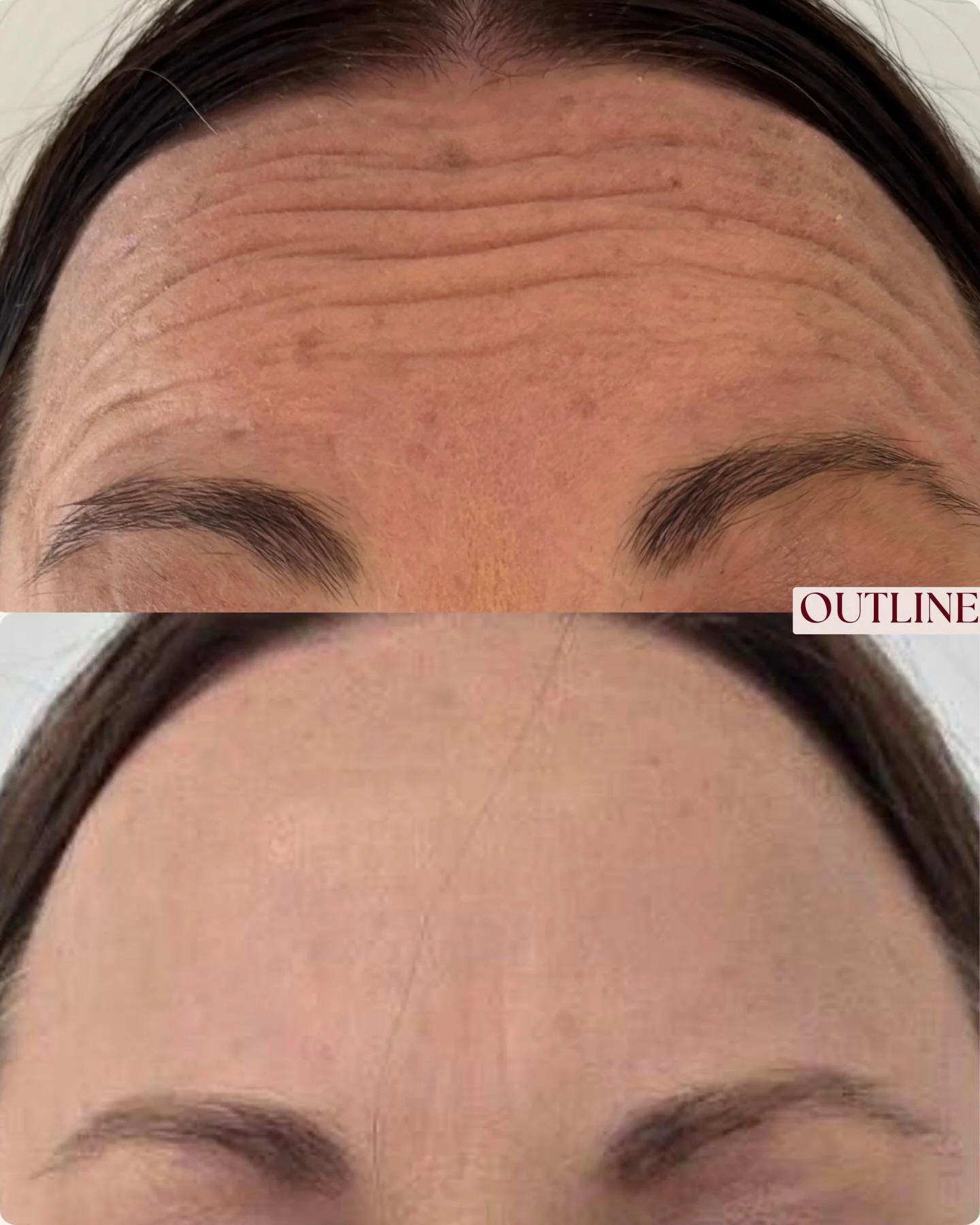 New year, new glow 💉✨ 

After photo taken and sent by client, hence the different lighting. All images are of animated expressions. Results predicted to last 3-4 months.

DM to book your complimentary consultation today at Outline ✨

________

Resul
