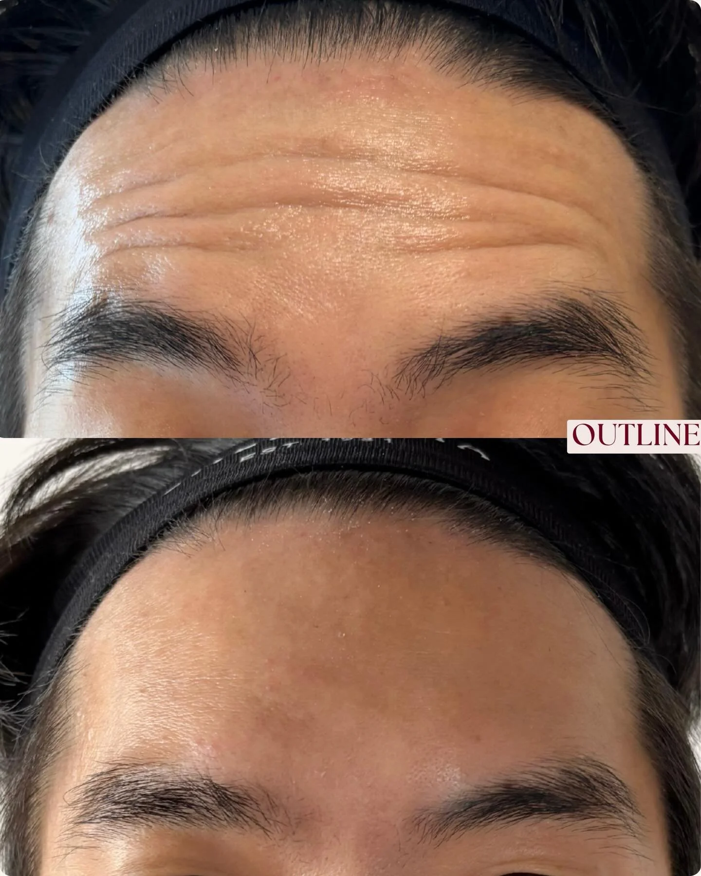 Just a little glow up- because why should women have all the fun 😎✨💉

All images are of animated expressions. 
Results predicted to last 3-4 months.

DM to book your complimentary consultation today at Outline ✨

________

Results vary between indi