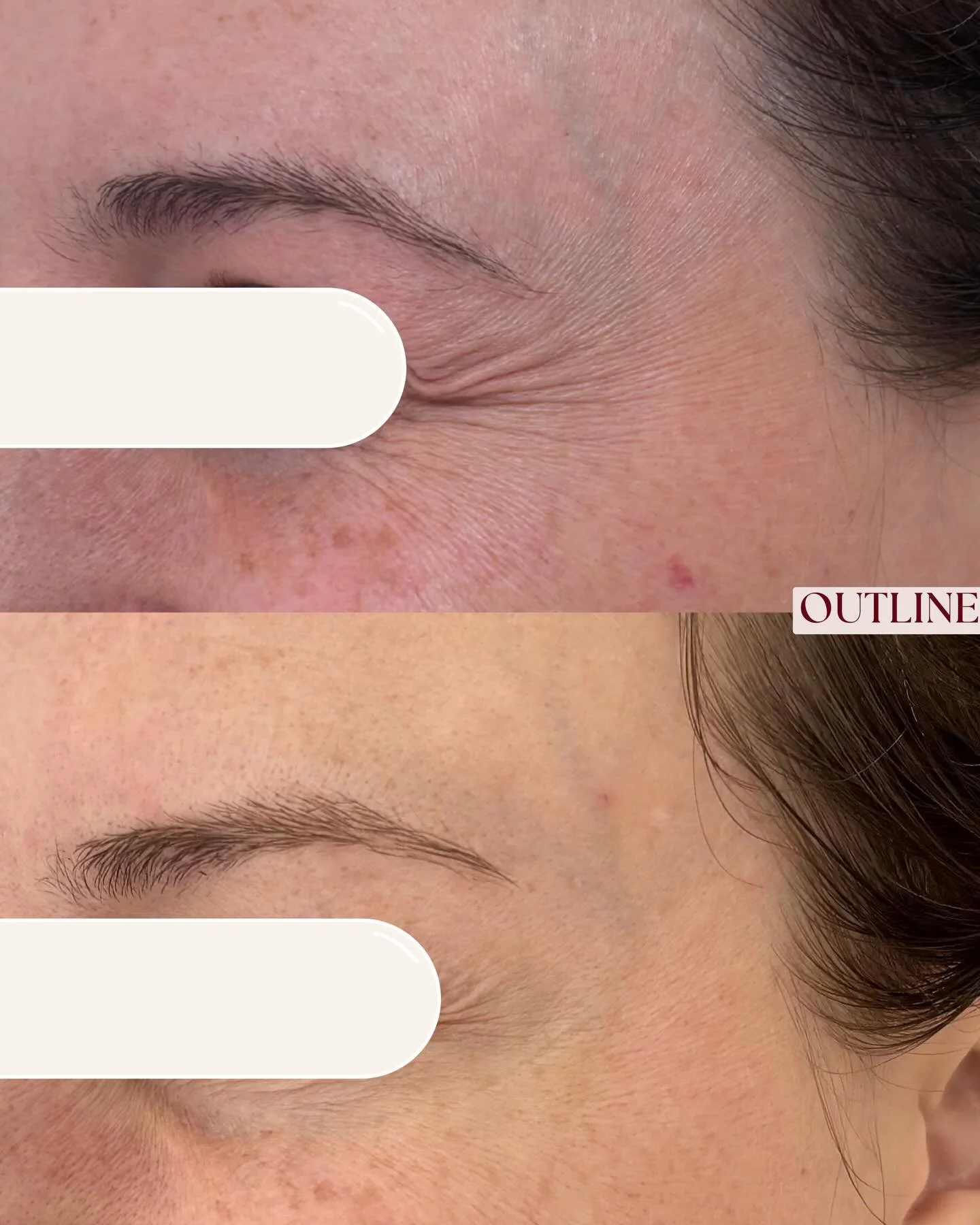 Softened crow&rsquo;s feet, smoother skin, and that beautifully arched brow line doing what it does best 😍

Tiny tweaks. Big confidence ✨

All images are of animated expressions. 
Results predicted to last 3-4 months.

________

Results vary between