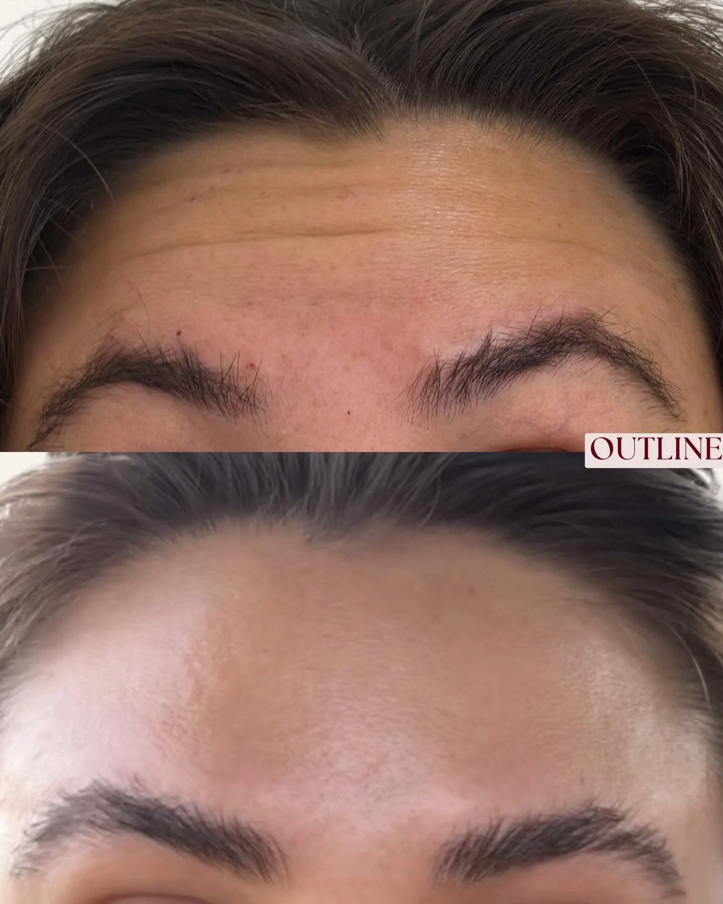 Before &amp; After: Forehead &amp; Frown Botox ✨

Softening the forehead lines and frown area while keeping natural expression intact and having that beautiful brow movement!

After photo note: the lighting is extra glowy because the client sent this
