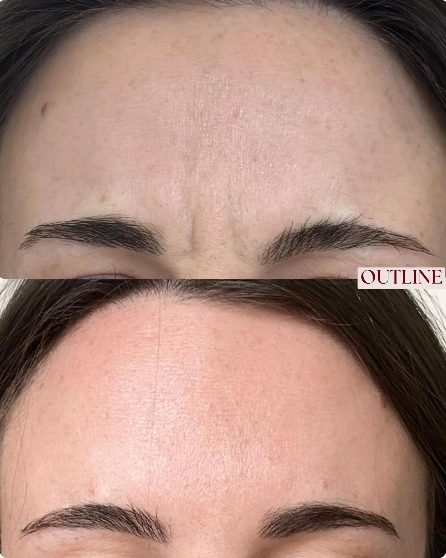 A simple, preventative approach to help stop lines getting deeper. Natural results, soft movement, and a fresh look 💉🤍

All images are of animated expressions. 
Results predicted to last 3-4 months.

DM to book your complimentary consultation today