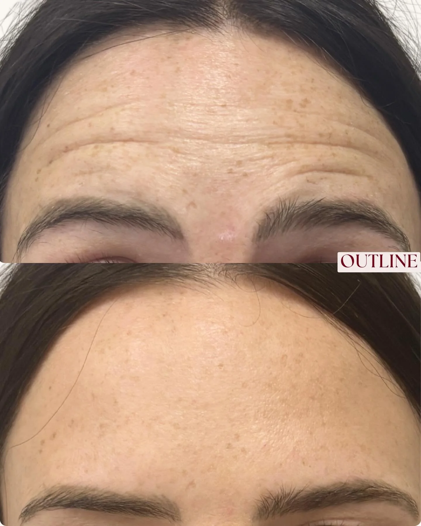 Before and After ✨ Dosage tailored to your goals 💉

All images are of animated expressions. 
Results predicted to last 3-4 months.

DM to book your complimentary consultation today at Outline ✨

________

Results vary between individuals. All inject