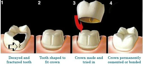 Sequence showing a decayed, fractured tooth, then a tooth shaped to fit a crown, the crown being placed on the tooth, and finally a crowned tooth that is cemented in.