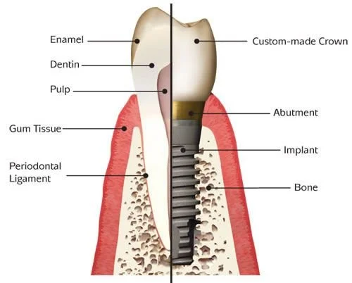 Diagram of a tooth and surrounding jawbone, showing the tooth's layers and dental implant components, including enamel, dentin, pulp, gum tissue, periodontal ligament, custom-made crown, abutment, implant, and bone.