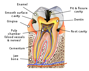 Diagram of a tooth showing enamel, smooth surface cavity, gingiva, pulp chamber, cementum, jaw bone, root cavity, dentin, pit and fissure cavity, and nerve fibers.