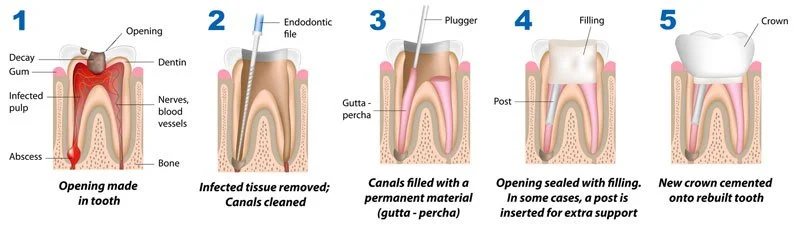 Step-by-step illustration of a root canal procedure, showing opening made in tooth, infected tissue removed and canals cleaned, canals filled with permanent material, filling post inserted, and new crown cemented onto the rebuilt tooth.