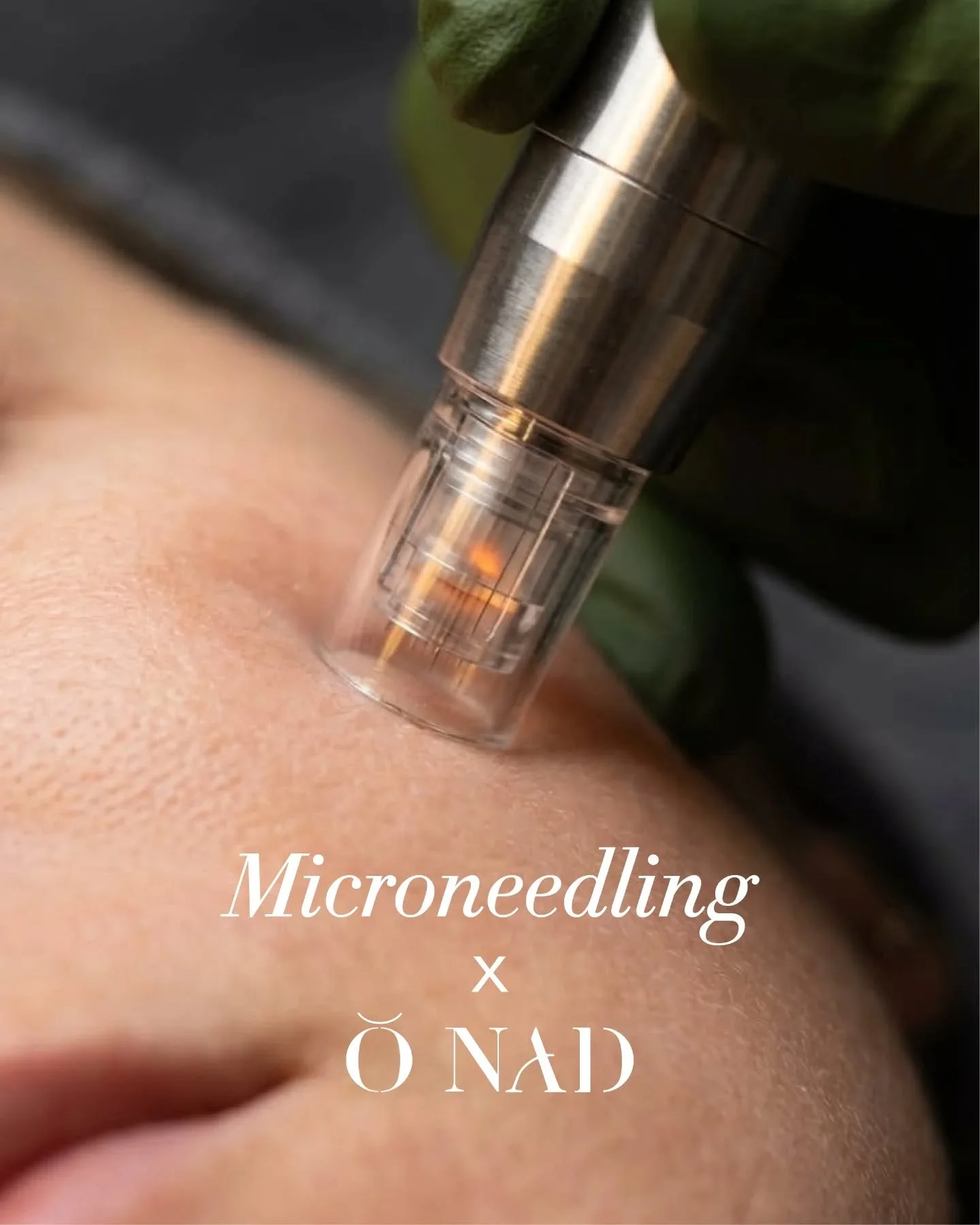 Powered by NAD+, peptides, and advanced bioactive ingredients, ŎNAD Face Solution works synergistically with microneedling to enhance skin rejuvenation, improve texture, support collagen production, while targeting fine lines, wrinkles, scars, and pi