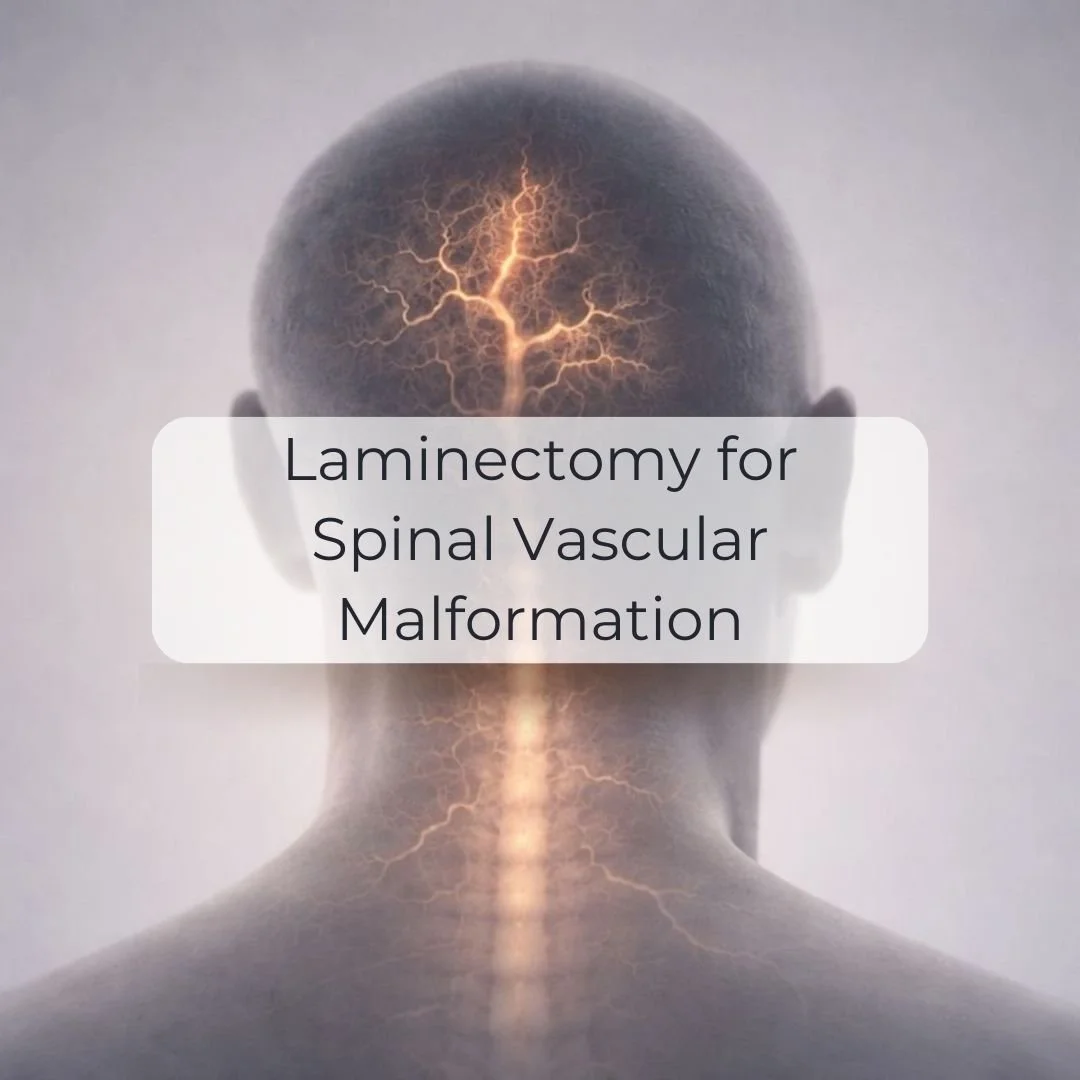 Laminectomy for spinal vascular malformation.jpg