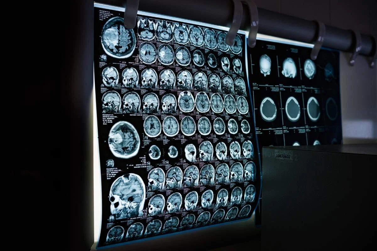 Scan on the brain showcasing a brain aneurysm as an incidental finding
