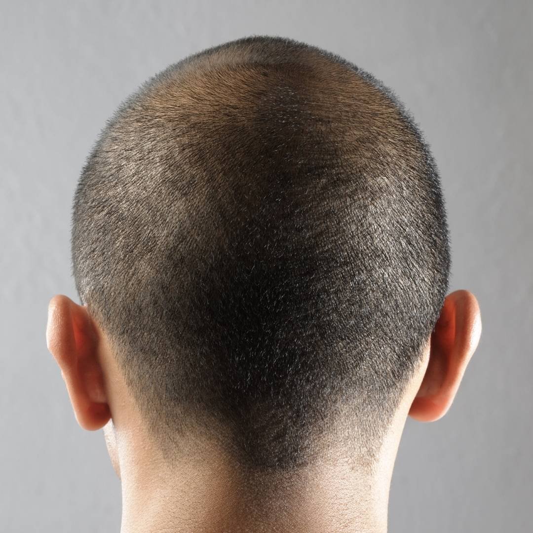 Man with Brain Aneurysm