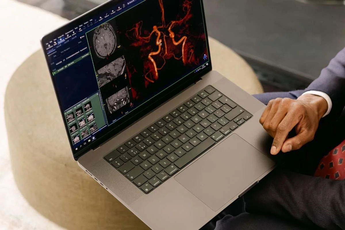Close up picture of Mr Vasan's laptop showcasing an aneurysm
