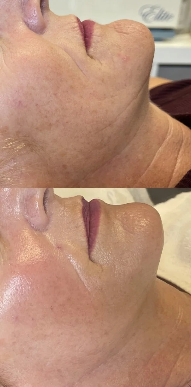 Close-up side view of a woman's face showing skin improvement, with before and after images highlighting reduced wrinkles and smoother skin.